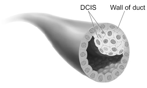 This picture shows ductal carcinoma in situ.